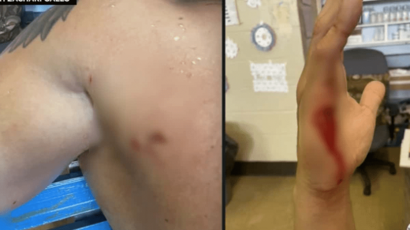   O salva-vidas de Smith Point Beach, Zack Gallo, foi mordido no peito e na mão direita durante seu terrível encontro (CBS New York/YouTube)