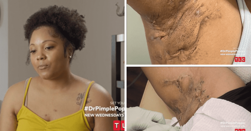 „Dr Pimple Popper“ 8 sezonas: Dr Sandra Lee padeda Chanel susidoroti su HS – nepagydoma būkle